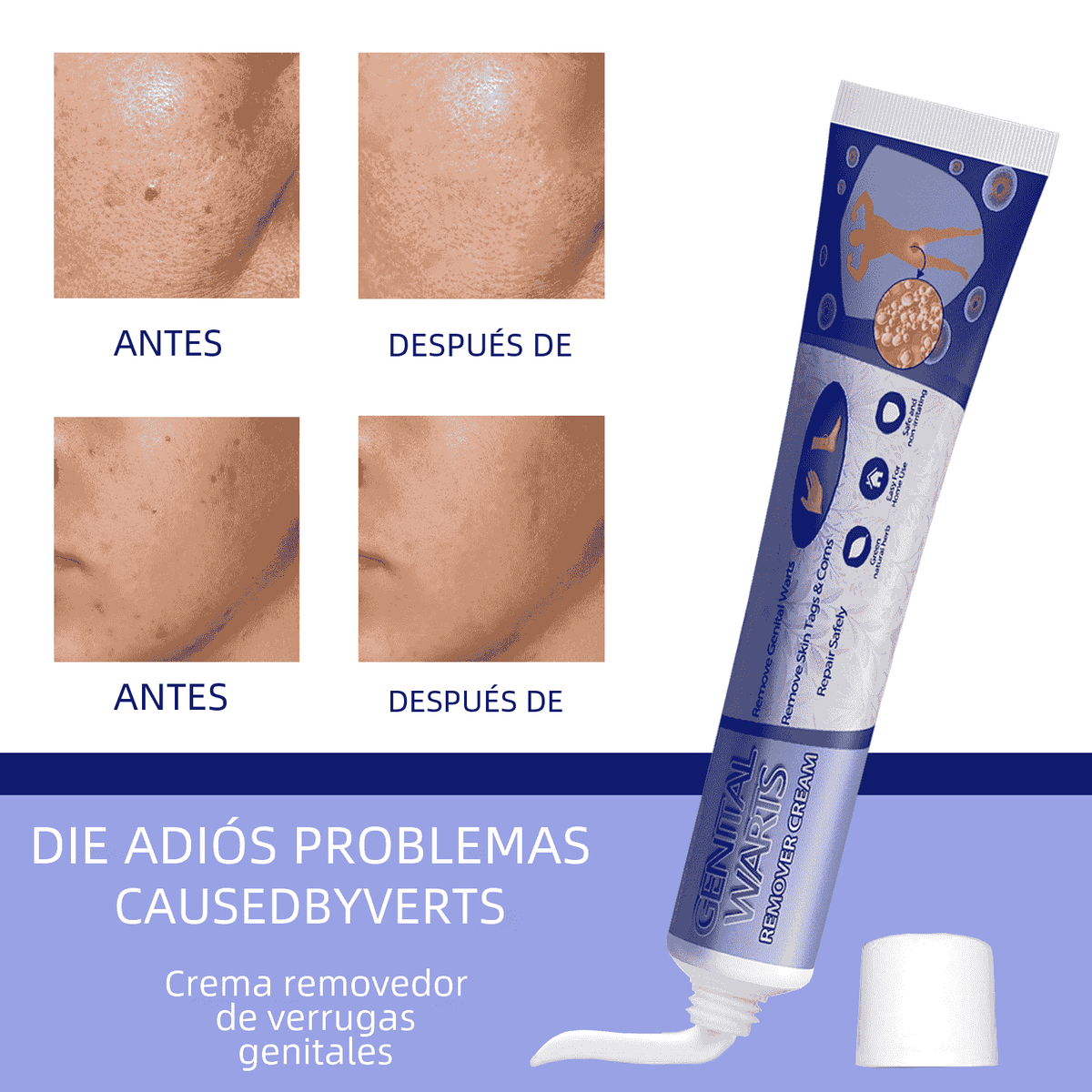 South Moon Wart Removal Cream for Skin Repair