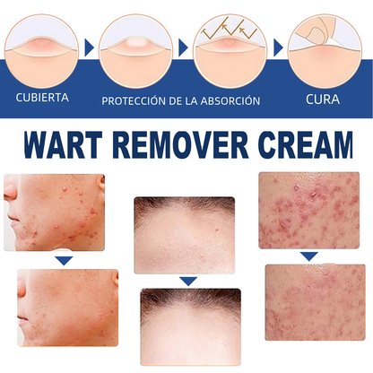 South Moon Wart Removal Cream for Skin Repair